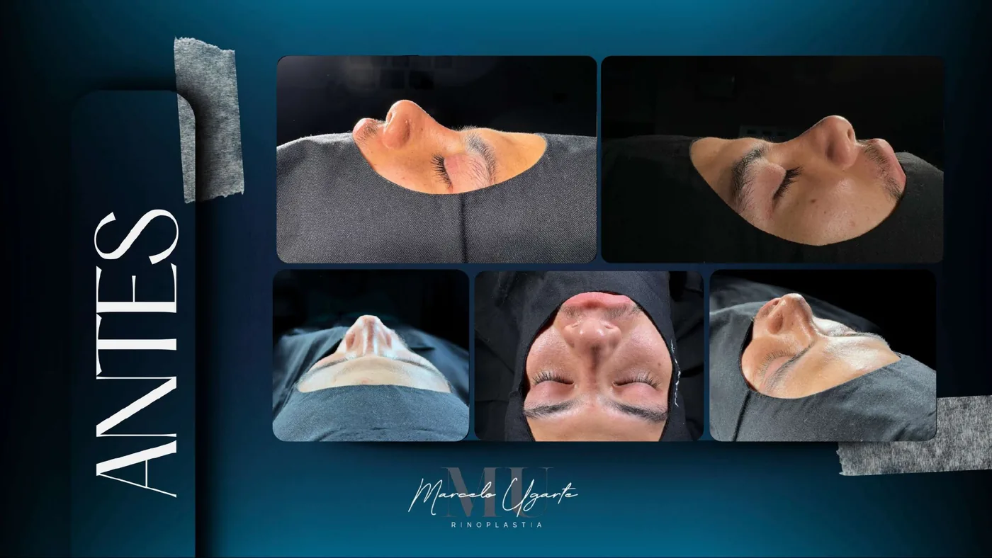Caso de reconstrucción nasal 1