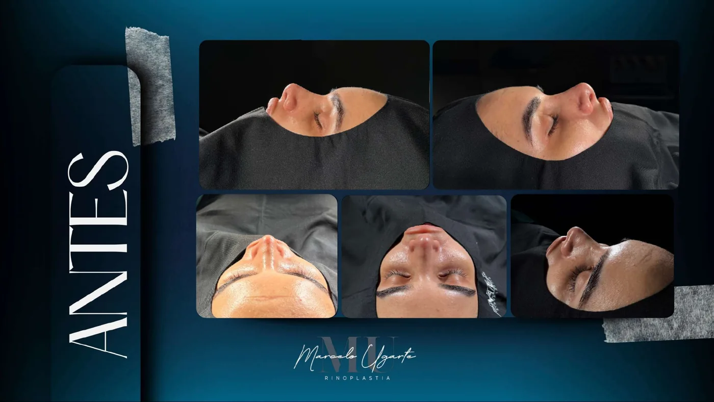 Caso de reconstrucción nasal 2